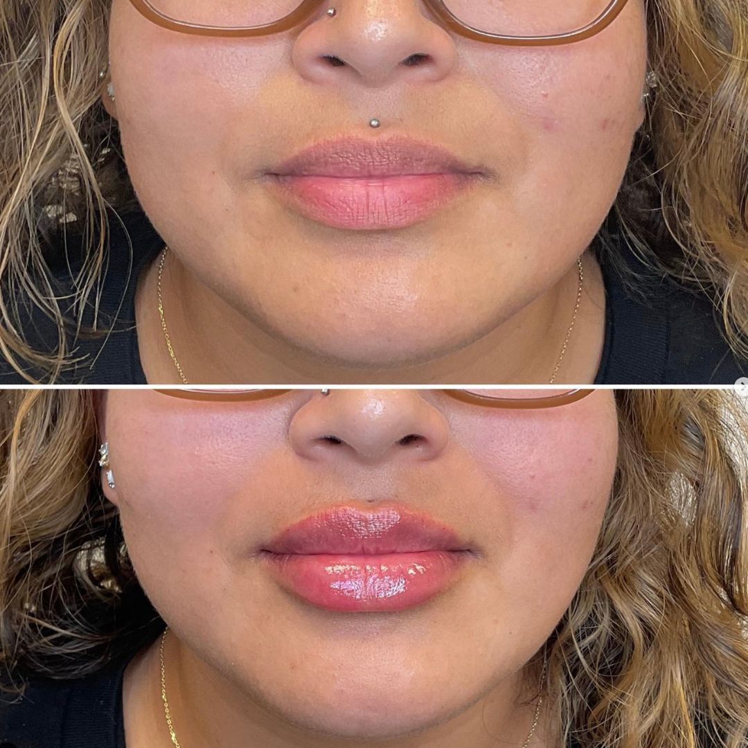 Lip Filler Before and After